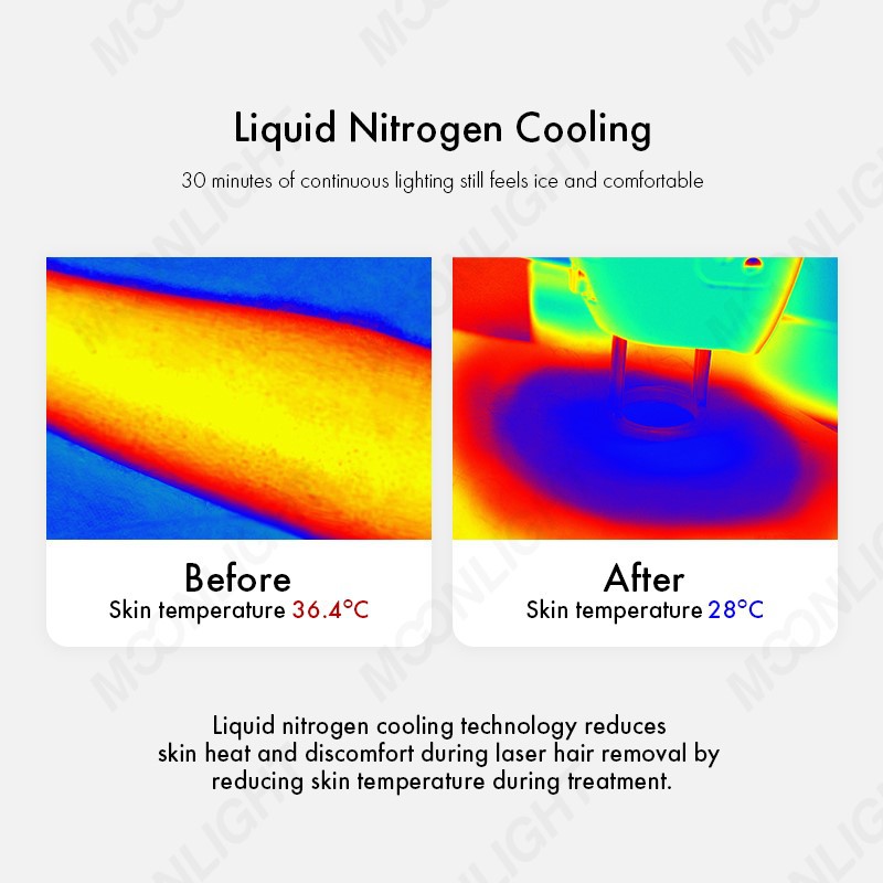 Alexandrite-laser-06