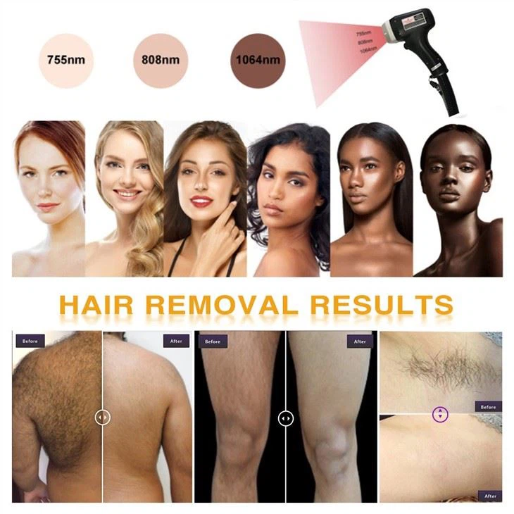 3 Wave Laser Soprano Titanium Hair Removal Machine
