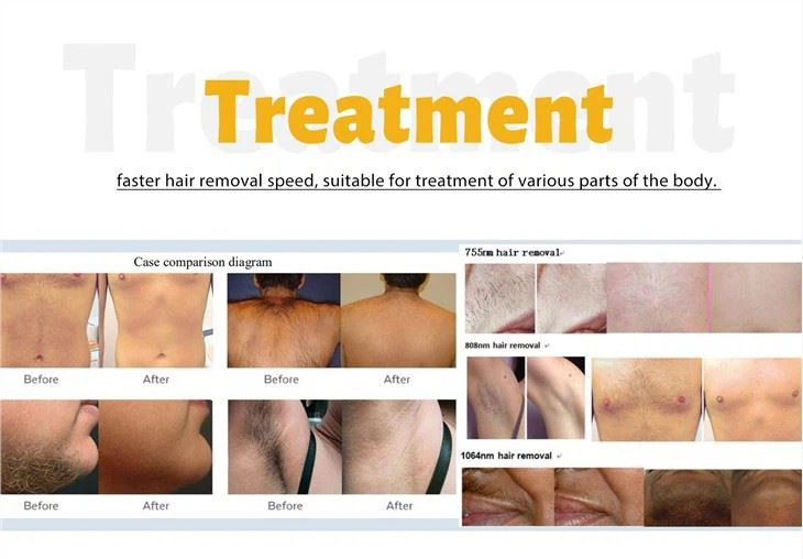 3 Wave Laser Soprano Titanium Hair Removal Machine