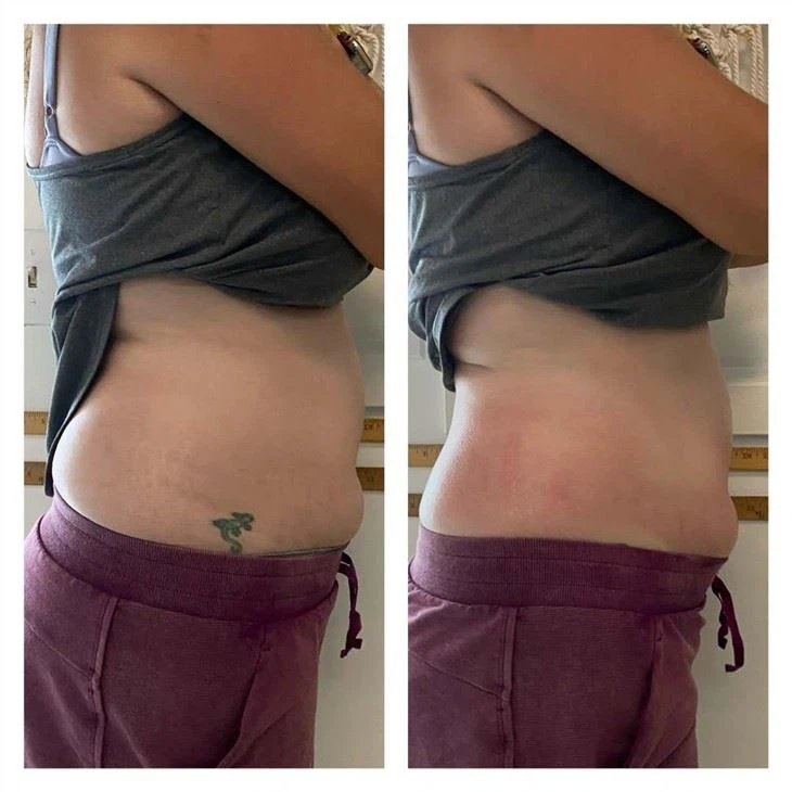 Cryoskin Fda Approved