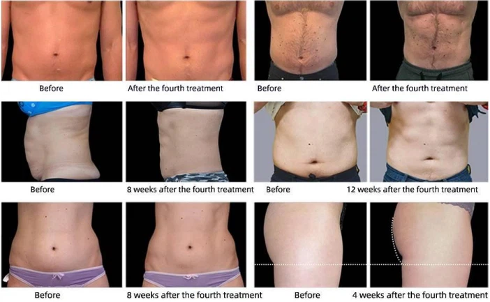 Best Ems Body Sculpt Machine