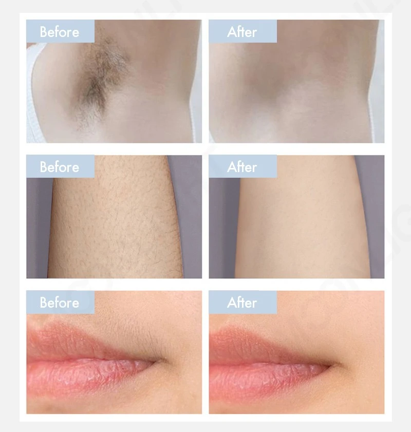 3500W High-Power Diode Laser Hair Removal Machine high quality