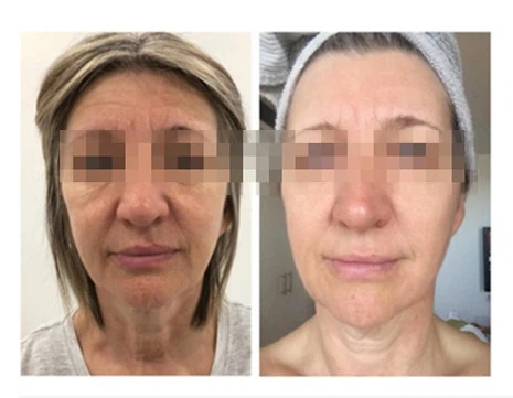 7D HIFU Machine Anti-Aging Solution