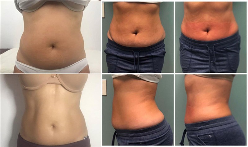 CryoSkin Machine — Advanced Thermal Shock Body Sculpting System price