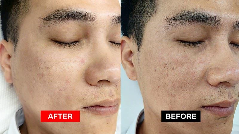 Crystallite Depth 8 RF Microneedling System high quality