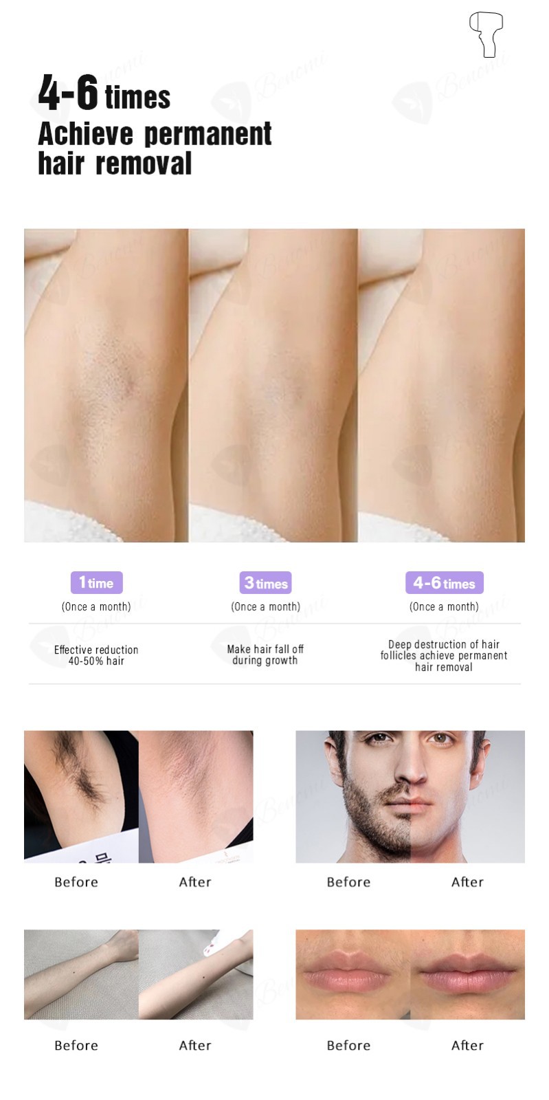 FDA Soprano Titanium Diode Laser Hair Removal Machine price