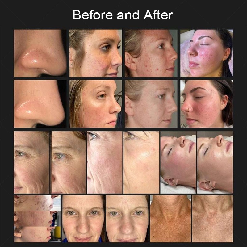 Fusion Plasma Machine – Advanced Plasma Skin Rejuvenation System For Clinics & Beauty Salons price