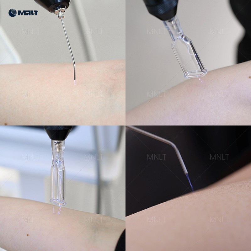 Fusion Plasma Machine – Advanced Plasma Skin Rejuvenation System For Clinics & Beauty Salons high quality