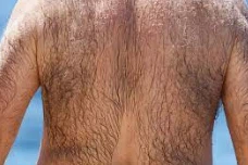 Classification of hirsutism