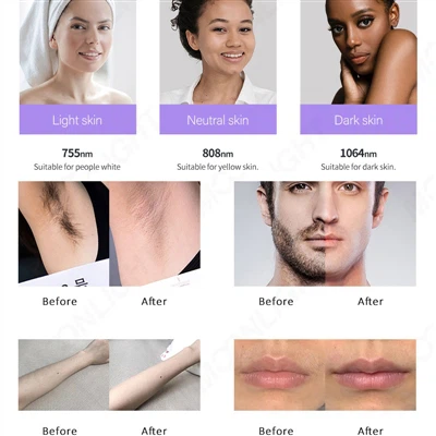 How to Choose a Good Laser Hair Removal Machine Manufacturer (Updated to 2024...