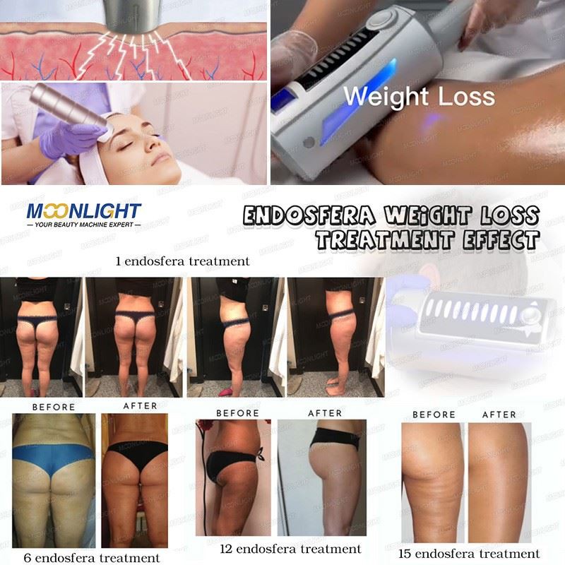 Inner Ball Roller Machine – Advanced Body Sculpting & Lymphatic Drainage Solution price