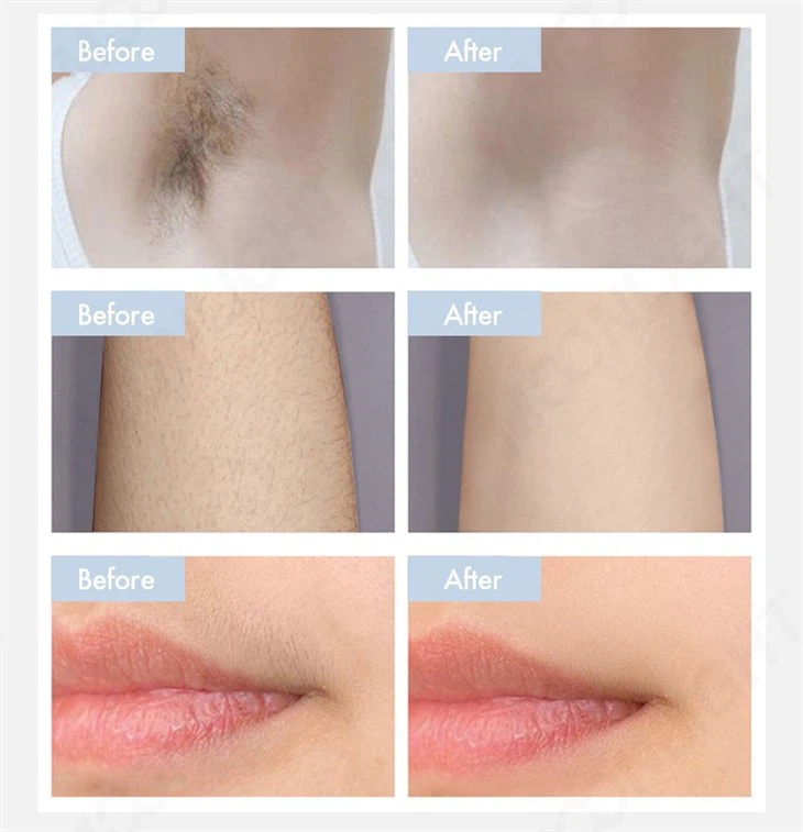 Laser Hair Removal Machine With Customer Management System