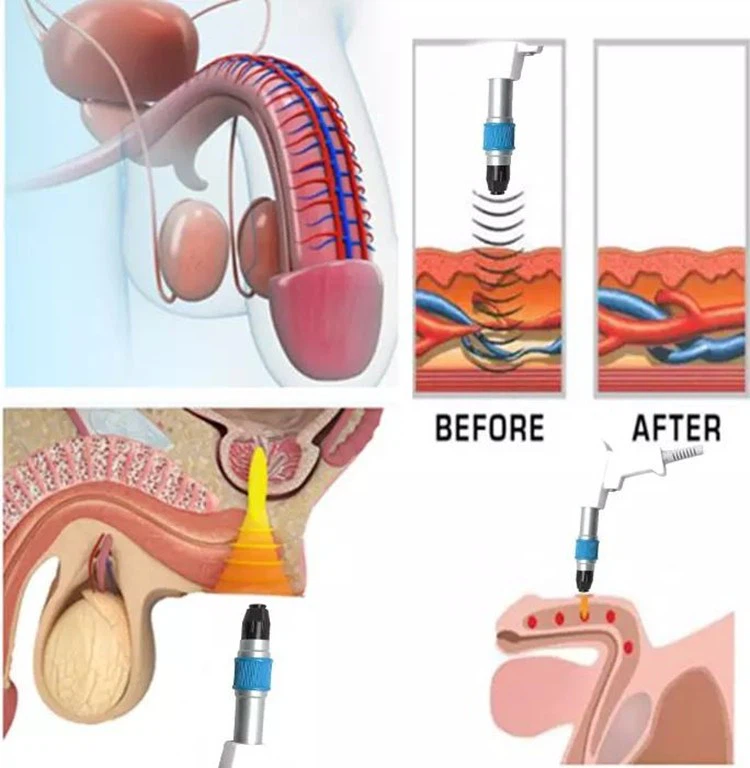 MNLT Shockwave Therapy System price