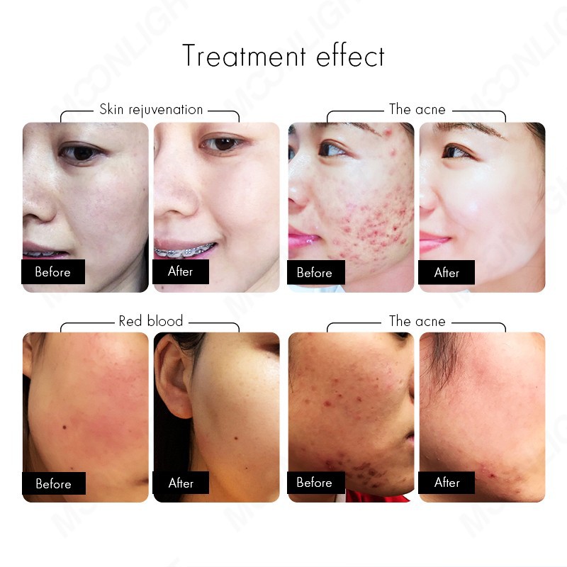 MOONLIGHT IPL-OPT + Diode Laser Hair Removal System price