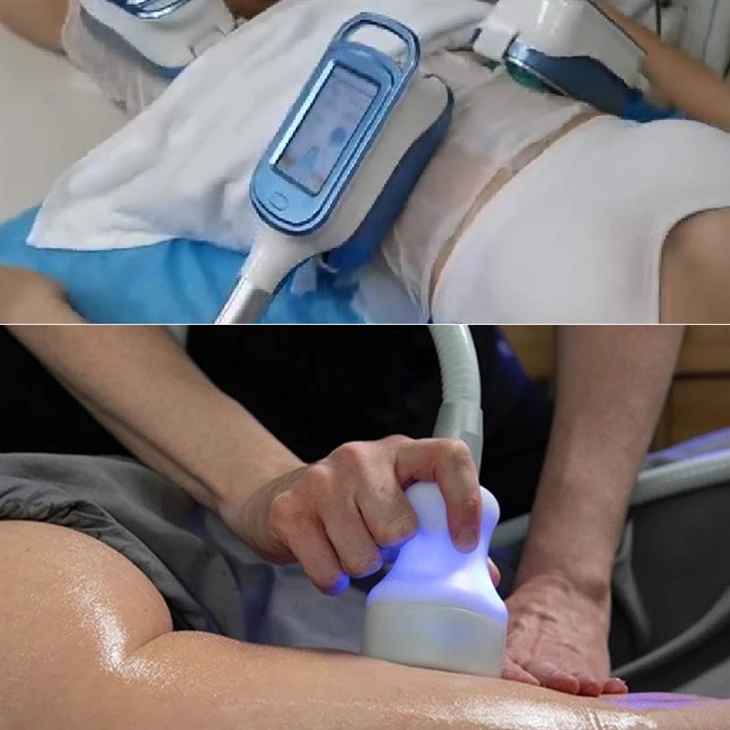 Coolsculpting Machine Cost