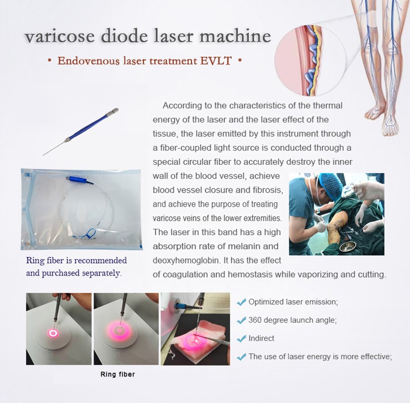 Varicose-vein-details Varicose-vein-details