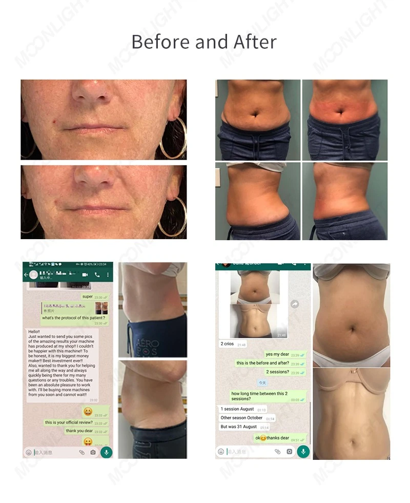 Professional Cryoskin Machine – Advanced Thermal Shock Body Sculpting System high quality