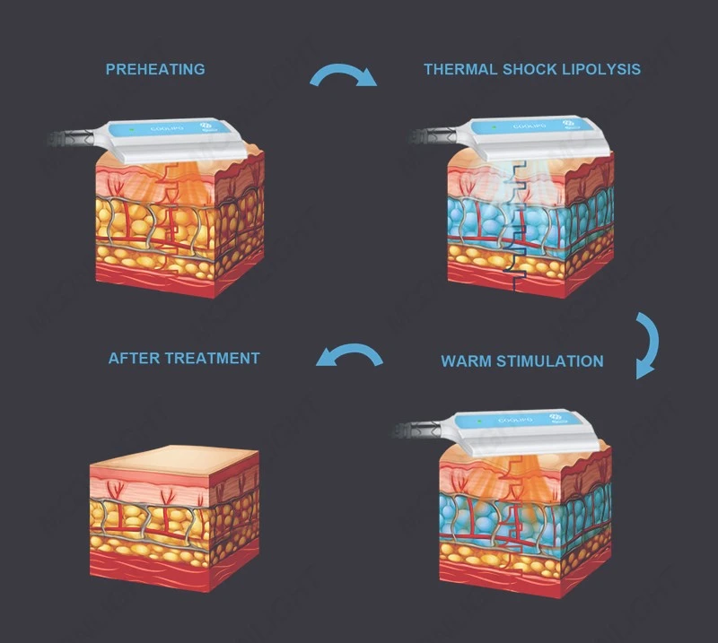 Professional Cryoskin Machine – Advanced Thermal Shock Body Sculpting System factory