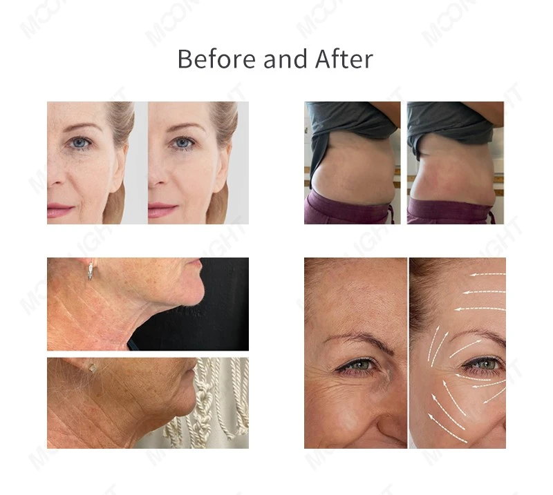 Professional Cryoskin Machine – Advanced Thermal Shock Body Sculpting System price