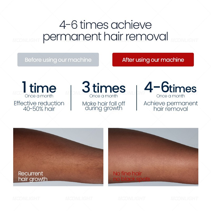 Selling Diode Laser Hair Removal Machine