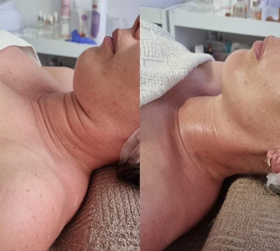SlimSphere Roller Therapy